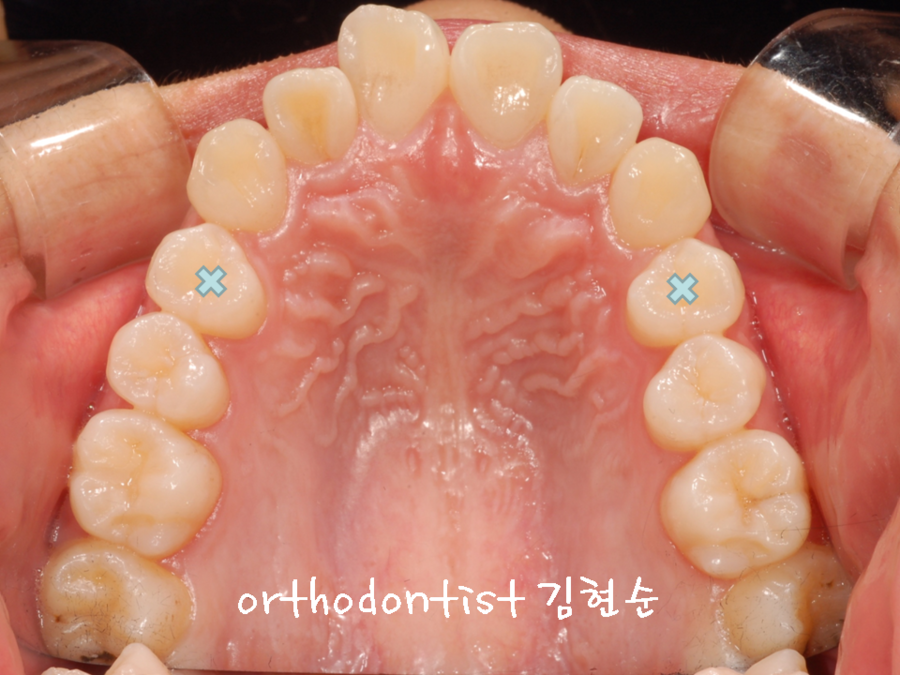 세라믹교정 은 세라믹치과 발치비발치 해결 관련 이미지 3