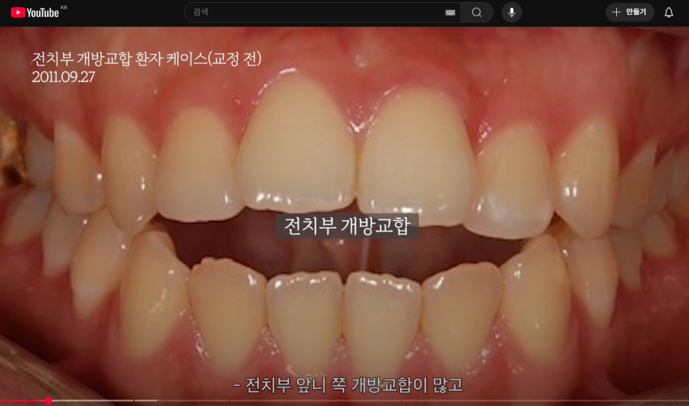 '개방교합' 치료법과 근본적인 해결방법 (feat. 비수술 치아교정) 관련 이미지 2