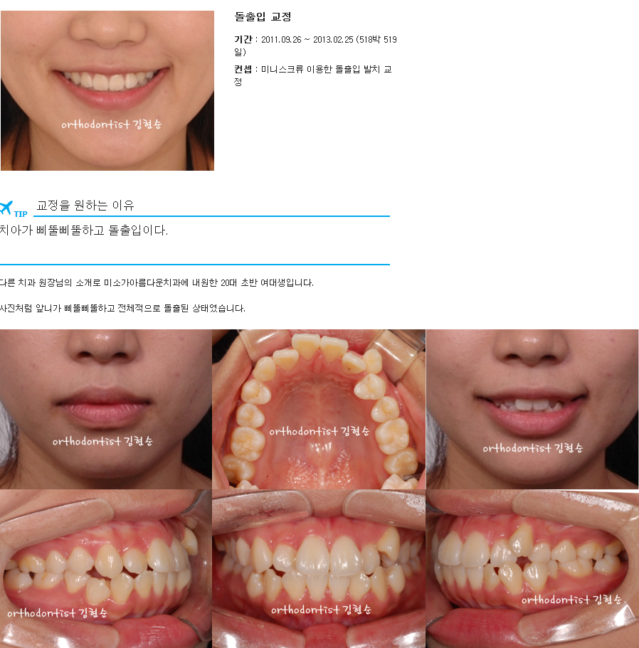 세라믹교정 세라믹치과-돌출입발치교정 4 관련 이미지 1