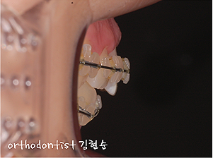 강남 돌출입 교정 관련 이미지 16