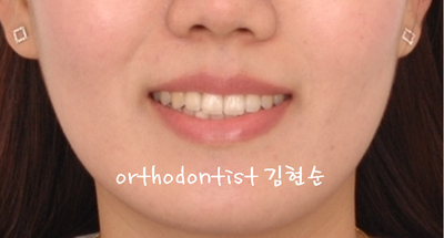 치열 교정 ( 벌어짐 ) 관련 이미지 25