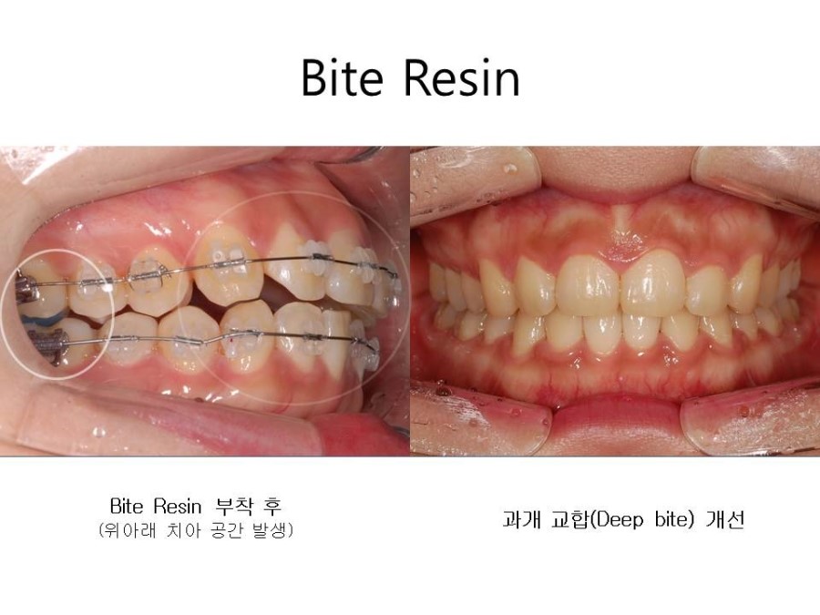 학동역치과 치아교정 잘하는 곳 ! 관련 이미지 16