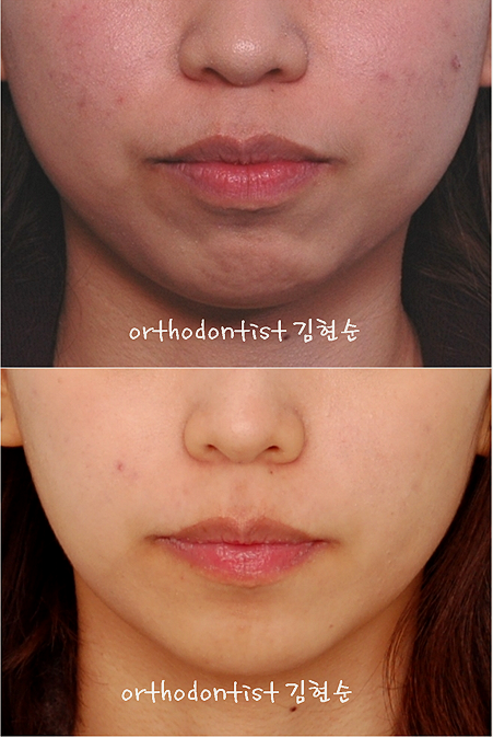 강남 돌출입 교정 관련 이미지 37