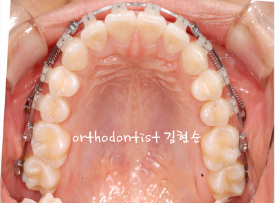 돌출 교정 (비발치 교정/비대칭) 관련 이미지 22