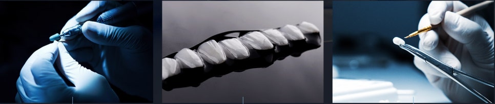 치아교정 VS. 라미네이트. 뭐가 좋은 걸까요? 관련 이미지 4