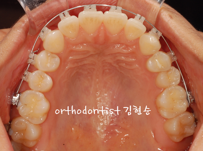 돌출 교정 (비발치 교정/비대칭) 관련 이미지 17