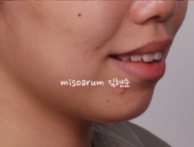 강남치아교정추천 관련 이미지 5