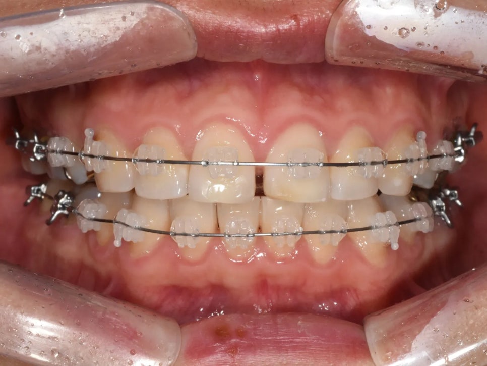 돌출입 재교정, 그것도 세 번째. 관련 이미지 7
