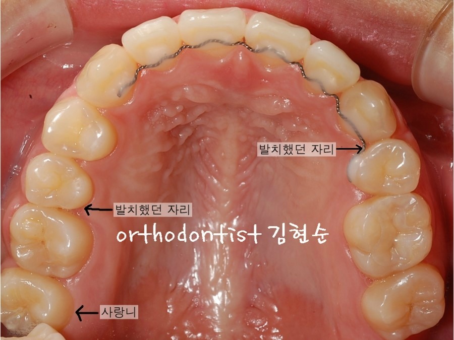세라믹교정 은 관련 이미지 8