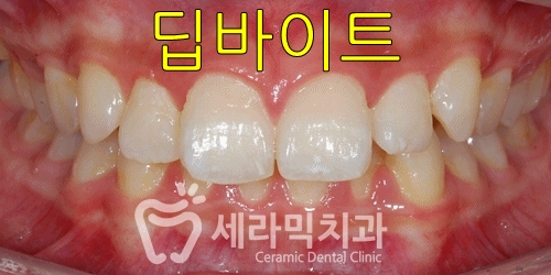 청소년교정 10대교정 딥바이트 과개교합 치아교정전후 관련 이미지 1