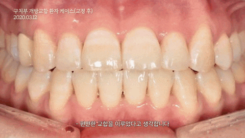 개방교합이란? 앞니와 어금니 상태에 따라 달라지는 교정 방향 관련 이미지 6