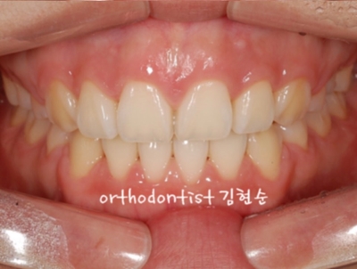 강남치아교정추천 관련 이미지 33