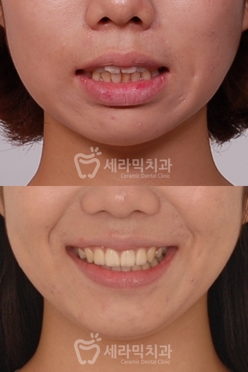 돌출입교정만 했을 뿐인데, 얼굴형과 무턱까지 개선된 치아교정전후 관련 이미지 8