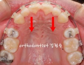 세라믹치과 "돌출입 발치교정" 관련 이미지 5
