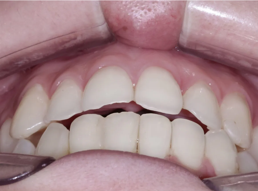 치아부식과 심미성을 동시에 잡은 앞니 치료 (ft. 역류성 식도염) 관련 이미지 6