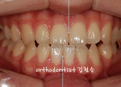 반대 교합 관련 이미지 5