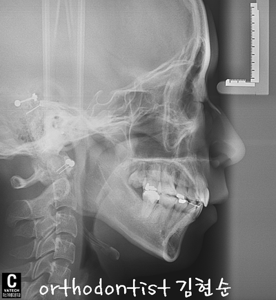 강남 돌출 관련 이미지 36