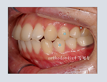 강남교정치과 관련 이미지 22