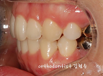 강남 돌출입 교정 관련 이미지 22