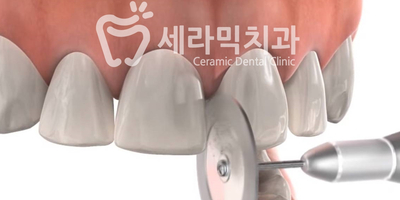 치아교정 부작용 제대로 알기 2. 관련 이미지 12