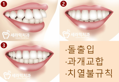 돌출입교정, 심미성과 치아 건강을 동시에 해결! 관련 이미지 2