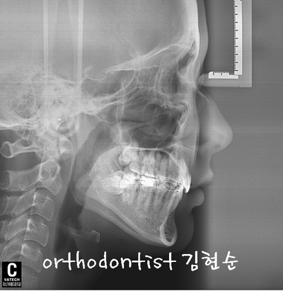 강남 돌출 (토끼 치아) 관련 이미지 36