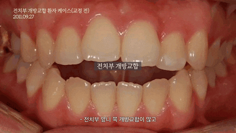 개방교합이란? 앞니와 어금니 상태에 따라 달라지는 교정 방향 관련 이미지 1