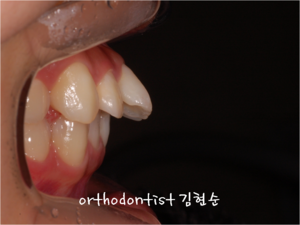 세라믹교정 은 세라믹치과 발치비발치 해결 관련 이미지 2