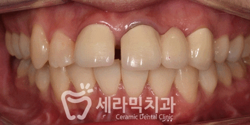 돌출입 치아벌어짐 치아재교정 전후. 세라믹치과 관련 이미지 8