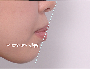 강남 돌출입 교정 관련 이미지 10