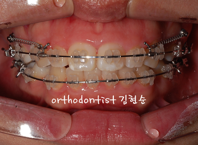 강남 돌출 관련 이미지 24