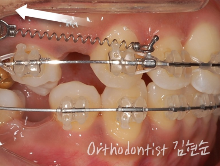 학동역치과 세라믹치과 교정리얼스토리 관련 이미지 3