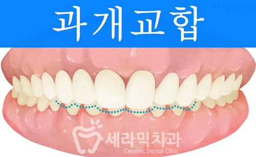 딥바이트 과개교합 치아교정전후 활짝 웃게 된 사례 관련 이미지 1