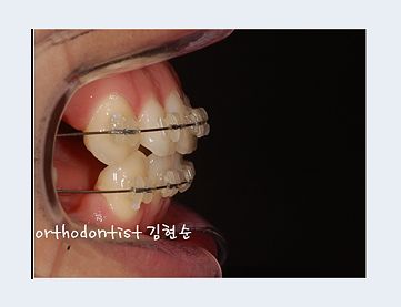 강남교정치과 관련 이미지 14