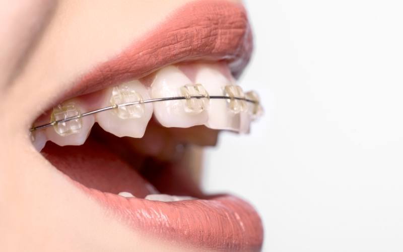 학동역치과 치아교정 잘하는 곳 ! 관련 이미지 6
