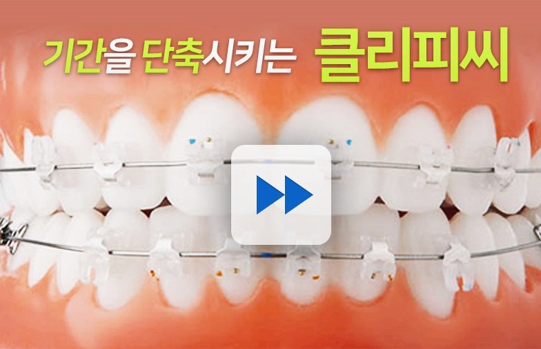 학동역치과 클리피씨 교정이란 ? 관련 이미지 5