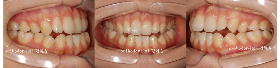 개방교합 비발치 세라믹교정 관련 이미지 7