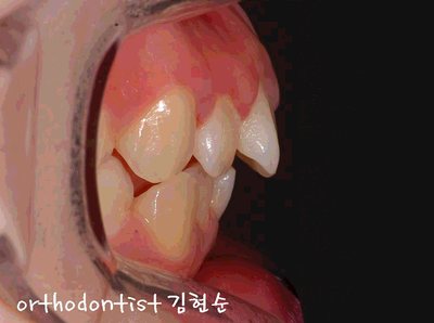 강남 돌출 관련 이미지 8