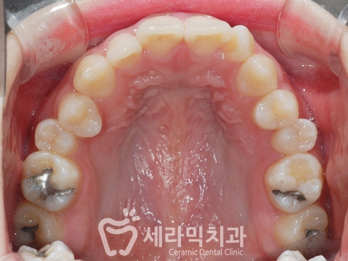 딥바이트(과개교합) 때문에 감추고 싶던 치아, 치아교정전후 달라진 미소 관련 이미지 2