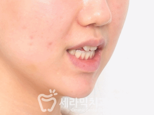 혀내밀기 습관과 개방교합, 오픈바이트(Open bite) 치아교정전후 보기 관련 이미지 11