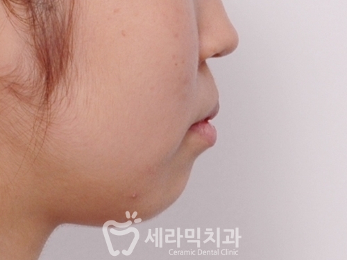 치아교정전후 영상 : 돌출입과 중심선비대칭 인상변화 관련 이미지 1