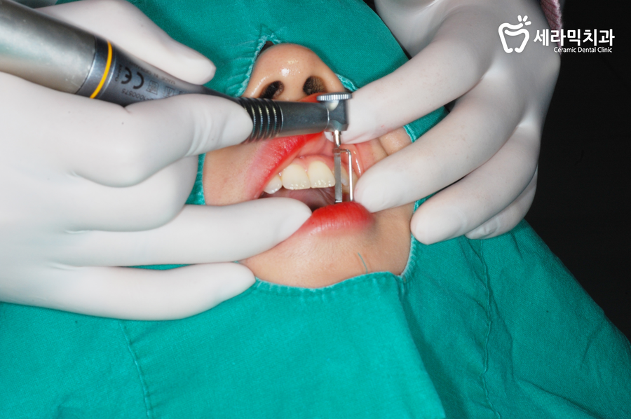 비발치교정 스트리핑이 필요 관련 이미지 2