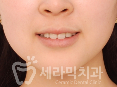 덧니 세라믹교정 전후사진, 학동역 세라믹치과 관련 이미지 5