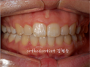 강남 돌출입 교정 관련 이미지 14