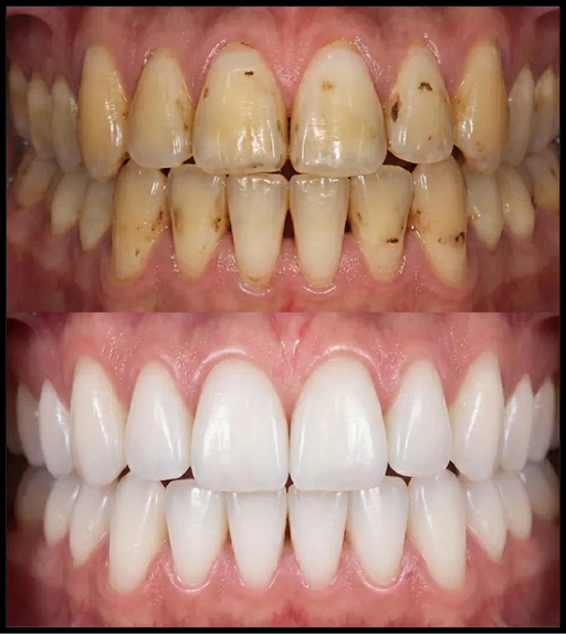 치아미백, 전문가 치아미백? 홈미백? 셀프미백? 총정리 관련 이미지 2