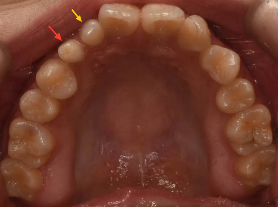 왜소치, 결손치가 동시에 있었던 환자의 앞니 심미보철 관련 이미지 4