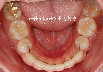 강남 돌출 관련 이미지 33