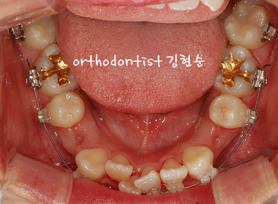 강남 덧니 관련 이미지 16