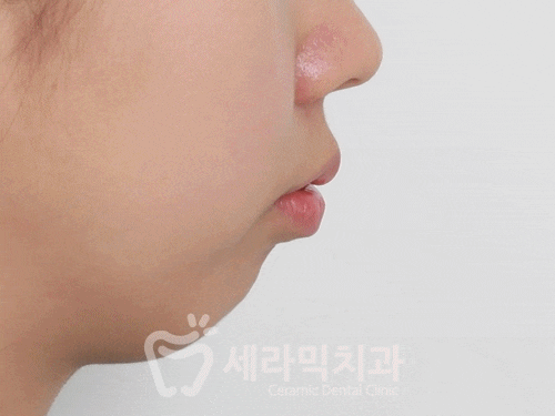 치아교정만으로 세마리 토끼를 한번에! 돌출입, 무턱, 치열불규칙 치아교정전후 관련 이미지 13