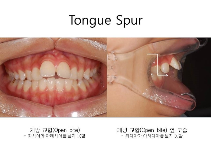 학동역치과 치아교정 잘하는 곳 ! 관련 이미지 21